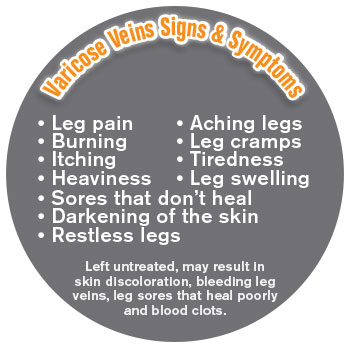 varicose veins signs and symptoms