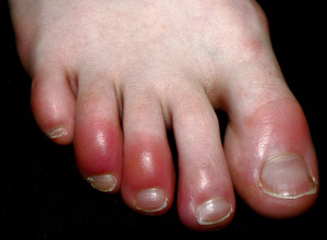covid toes