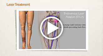 Laser Treatment of Varicose Veins