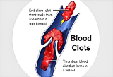 Blood Clots